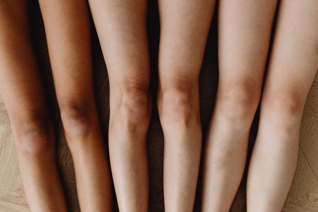 Rodilla inflamada con acumulación de líquido