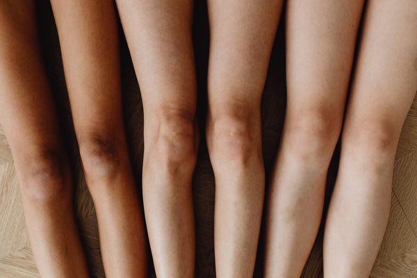 Líquido en la rodilla (derrame): por qué pasa y qué hacer